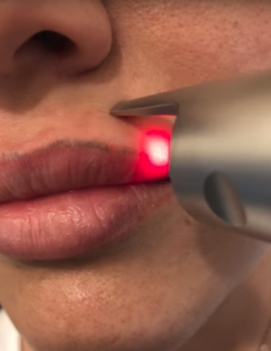 Eliminación con láser de maquillaje permanente (tatuaje) de cejas, labios, párpados