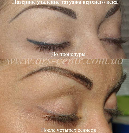 Pag-alis ng laser ng permanenteng makeup (tattoo) ng eyebrows, labi, eyelids