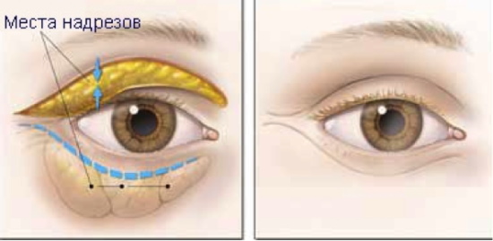 Pembedahan plastik pada kelopak mata. Sebelum dan selepas gambar, harga, ulasan