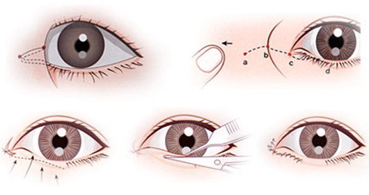 Pembedahan plastik pada kelopak mata. Sebelum dan selepas gambar, harga, ulasan