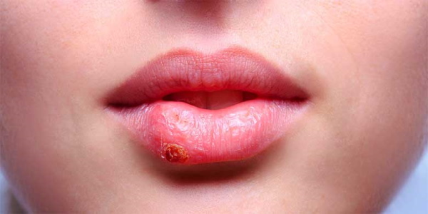 Las chicas tienen labios finos. Cómo aumentar con ácido hialurónico, relleno, botox